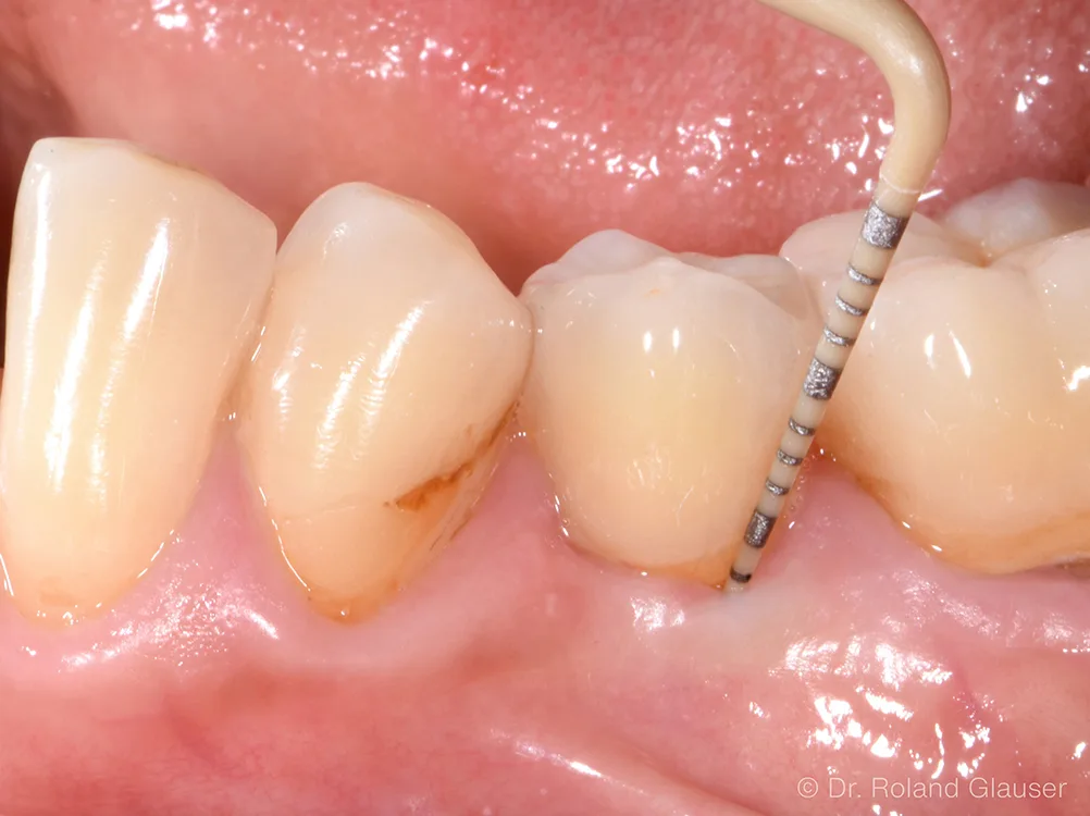 Abb. 3: Ein Patent™ Symbionic Tooth nach 4.5 Jahren: Die maximale Sondierungstiefe von 3 mm entspricht dem physiologischen Zustand eines gesunden natürlichen Zahns