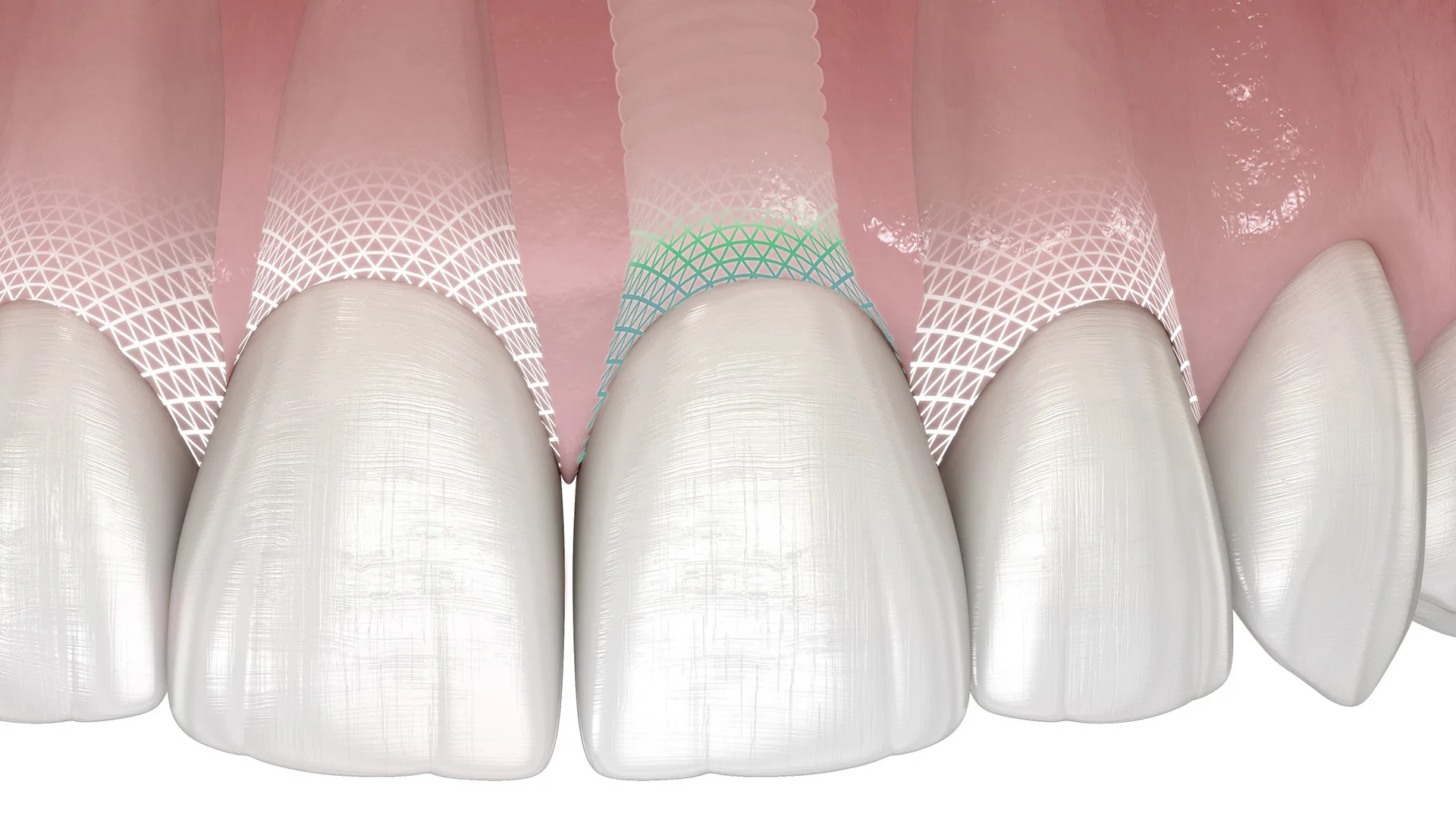 atent™ Symbionic Teeth sind der Zahnersatz der neuesten Generation. Sie erzeugen eine mukosale Schutzbarriere gegen Plaque und Bakterien nach Vorbild des natürlichen Zahns. Langzeitstudien zufolge ist dieser medizinische Durchbruch der Schlüssel zu langfristig gesundem Gewebe und stabilen ästhetischen Resultaten von festsitzendem Zahnersatz