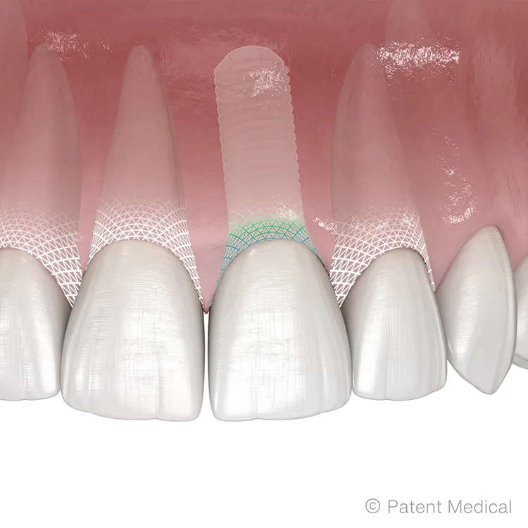 Abb. 4: Patent™ Symbionic Teeth sind der Zahnersatz der neuesten Generation. Sie erzeugen eine mukosale Schutzbarriere gegen Plaque und Bakterien nach Vorbild des natürlichen Zahns. Langzeitstudien zufolge ist dieser medizinische Durchbruch der Schlüssel zu langfristig gesundem Gewebe und stabilen ästhetischen Resultaten von festsitzendem Zahnersatz