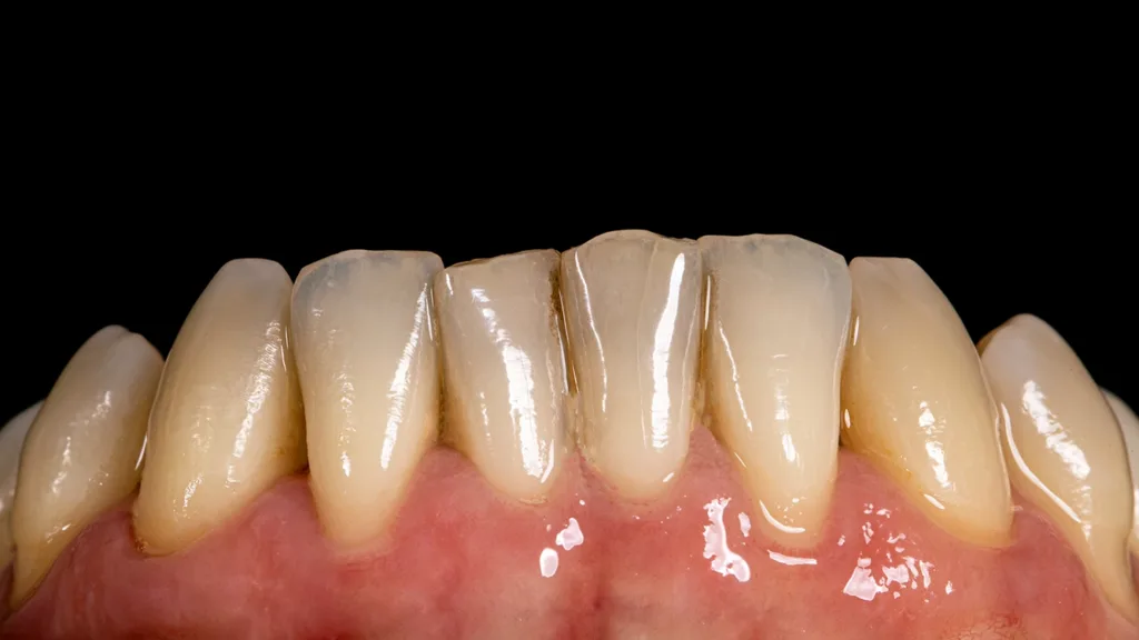 Ansicht von Ober- und Unterkieferzähnen von Eckzahn zu Eckzahn mit Kontrastplatte