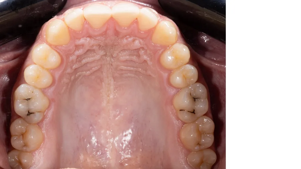 Okklusale Ansicht des gesamten Ober- und Unterkiefers mit Spiegel