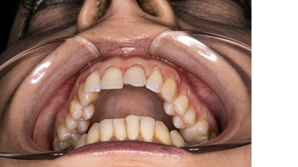 Ein falscher Winkel bei der intraoralen Fotografie und eine falsche Rahmung führen zu verzerrten Darstellungen.