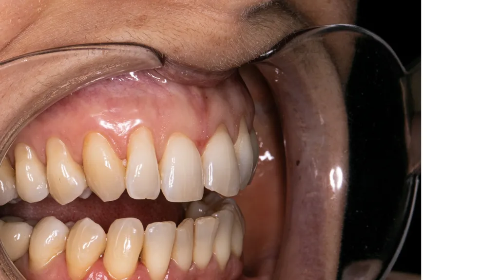 Ein falscher Winkel bei der intraoralen Fotografie und eine falsche Rahmung führen zu verzerrten Darstellungen.