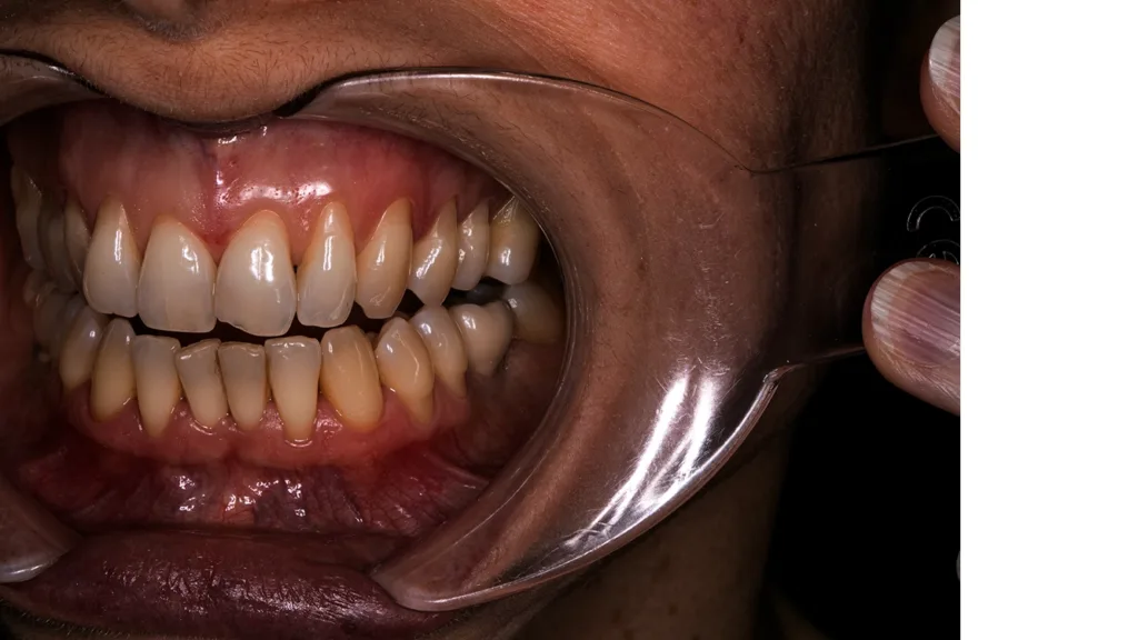 Unterbelichtung und Überbelichtung beeinträchtigen die Bildqualität.