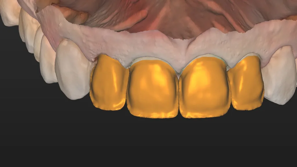 Frontalansicht der Kronen in ihrem finalen Cut-back-Design