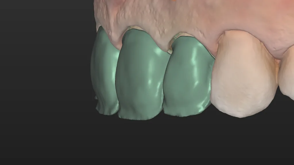 Seitenansicht der Kronen in der CAD-Software