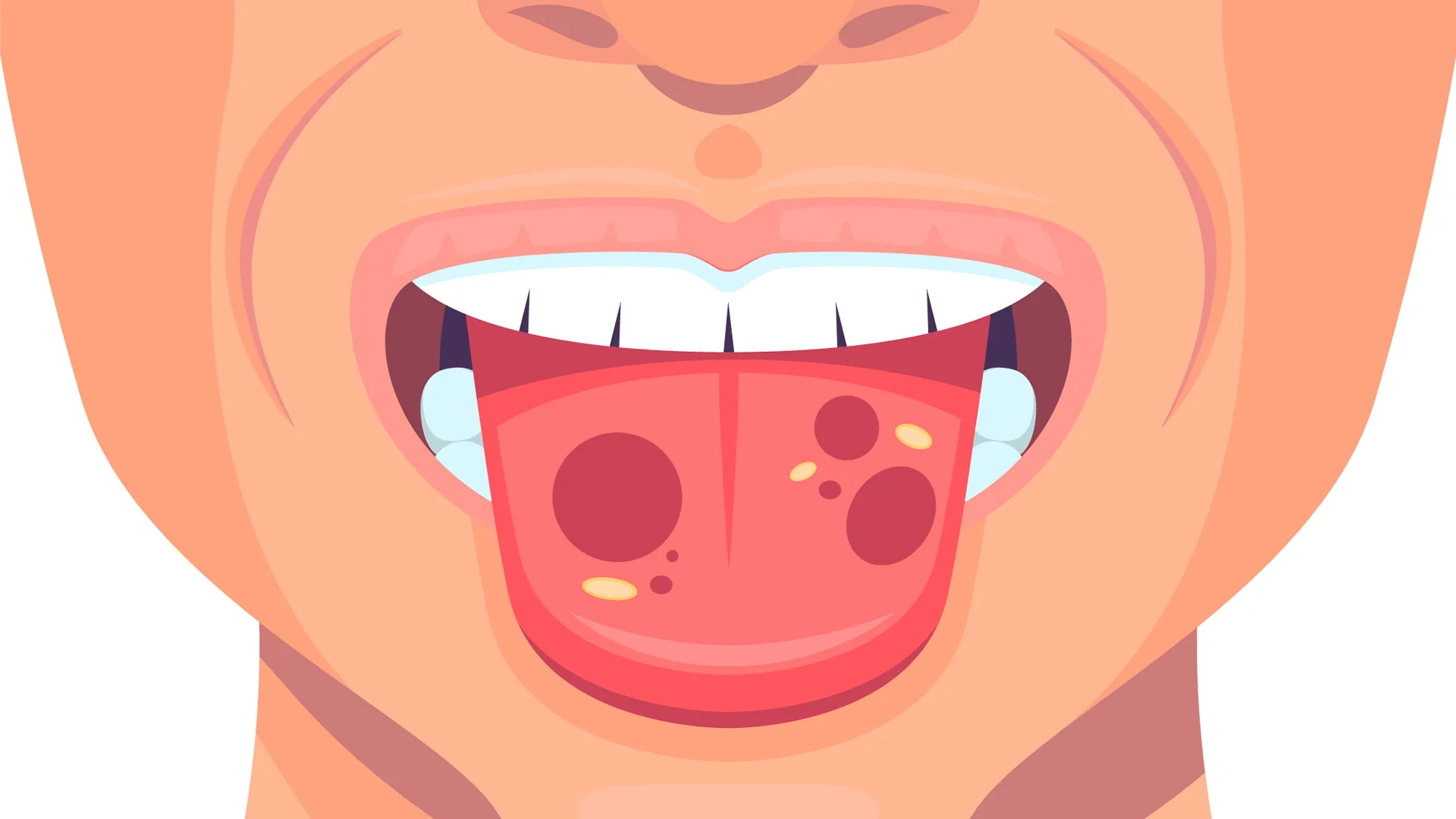 Illustration einer Frau, die ihre Zunge rausstreckt. Auf der Zunge befinden sich Bakterien.