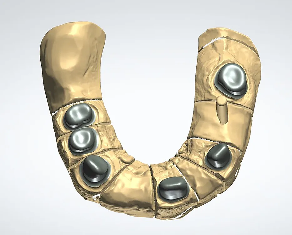 Abb. 10: Fertig designte Primärteleskope OK in okklusaler Ansicht.