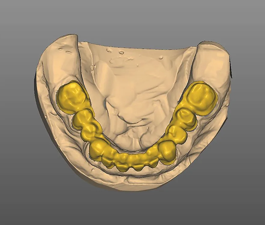 Abb. 15: Konstruierte Brücke im UK in okklusaler Ansicht.
