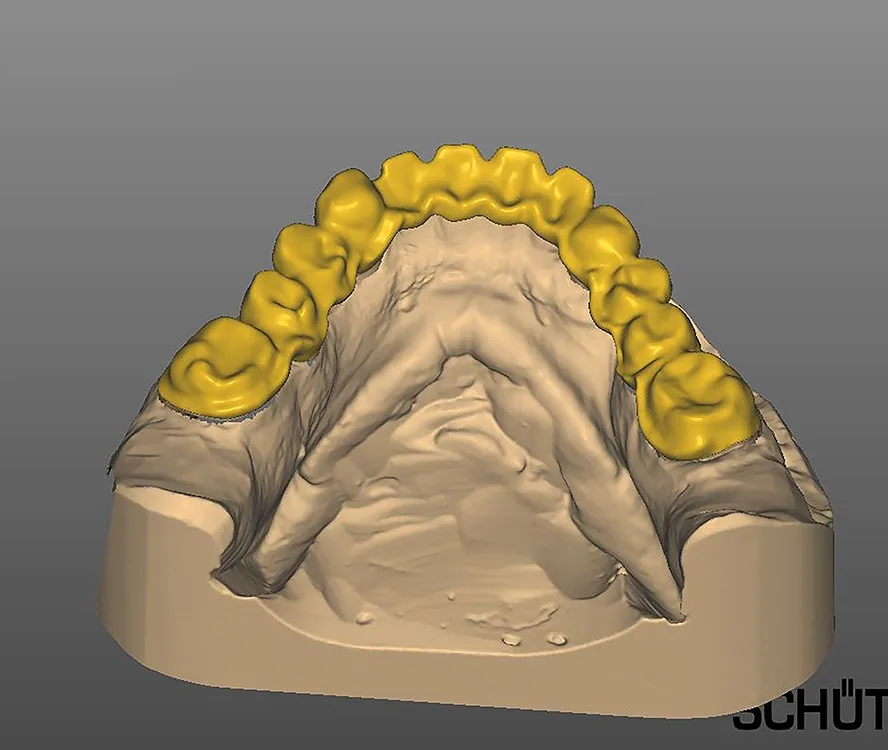 Abb. 16: Konstruierte Brücke im UK in lingualer Ansicht.
