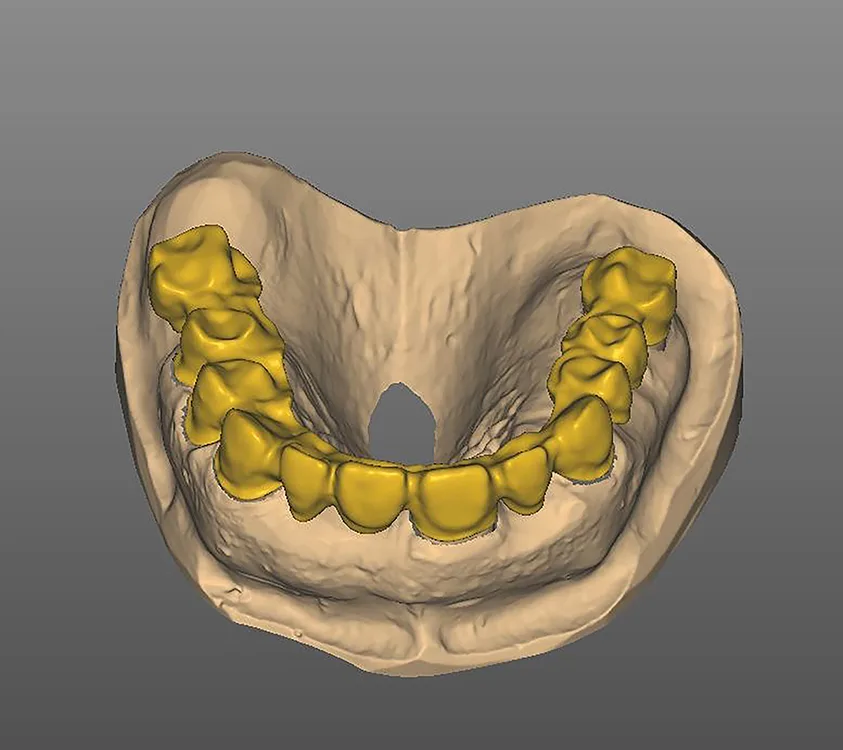 Abb. 17: Konstruierte Brücke im OK in frontaler Ansicht.