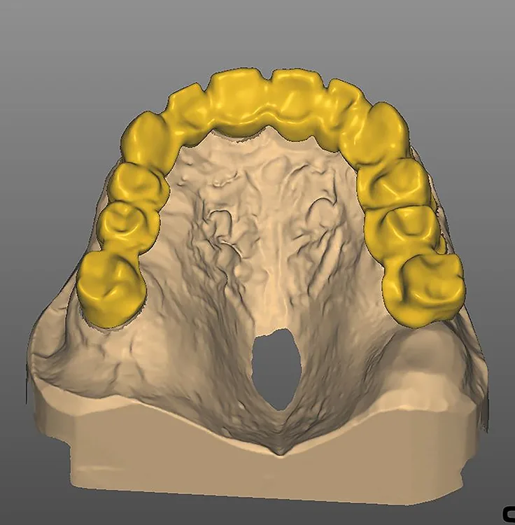 Abb. 18: Konstruierte Brücke im Ok in palatinaler Ansicht.