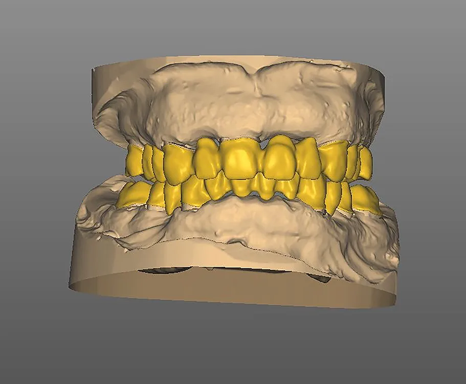 Abb. 19: Konstruierte Brücken in Okklusion.
