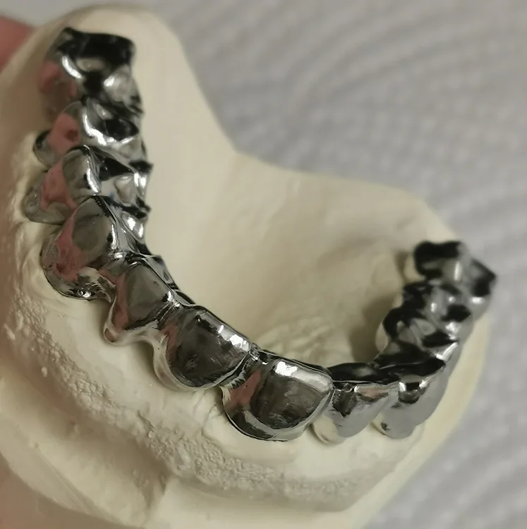 Abb. 20: Ausgearbeitete Brücke im Oberkiefer.