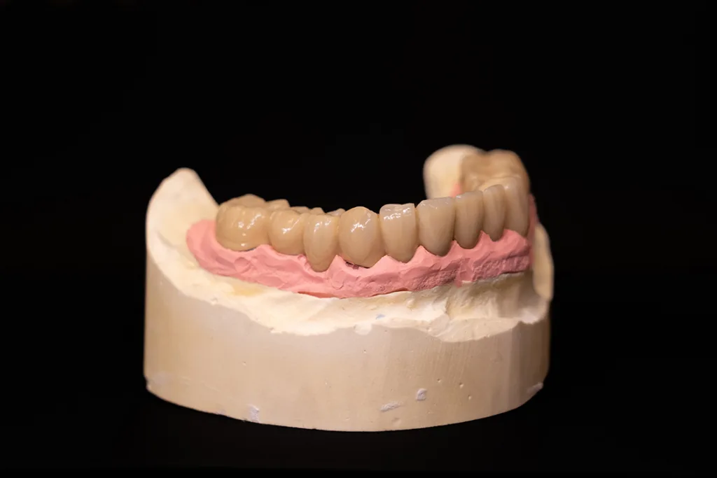 Abb. 23: Die Brücke passt sich perfekt an die Gingiva an (UK).