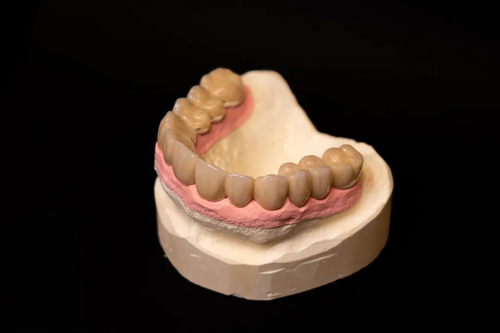 Abb. 24: Die Brücke passt sich perfekt an die Gingiva an (OK).