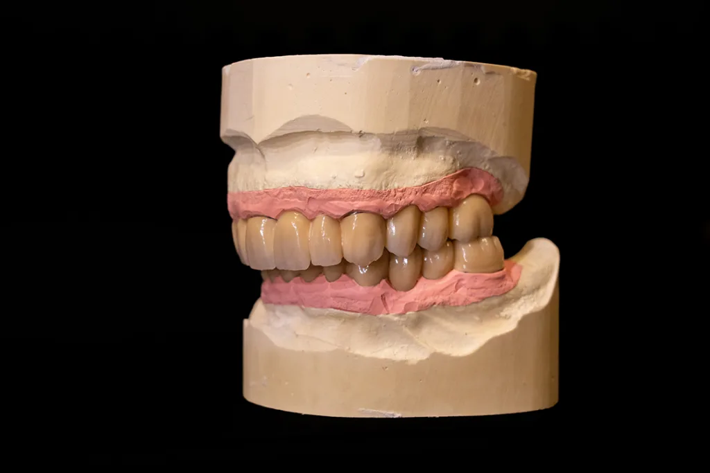 Abb. 25: Die fertige Arbeit in Okklusion.