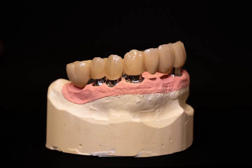 Abb. 27: Eine optimale Friktion entsteht durch die gute Passung der Sekundärteile.