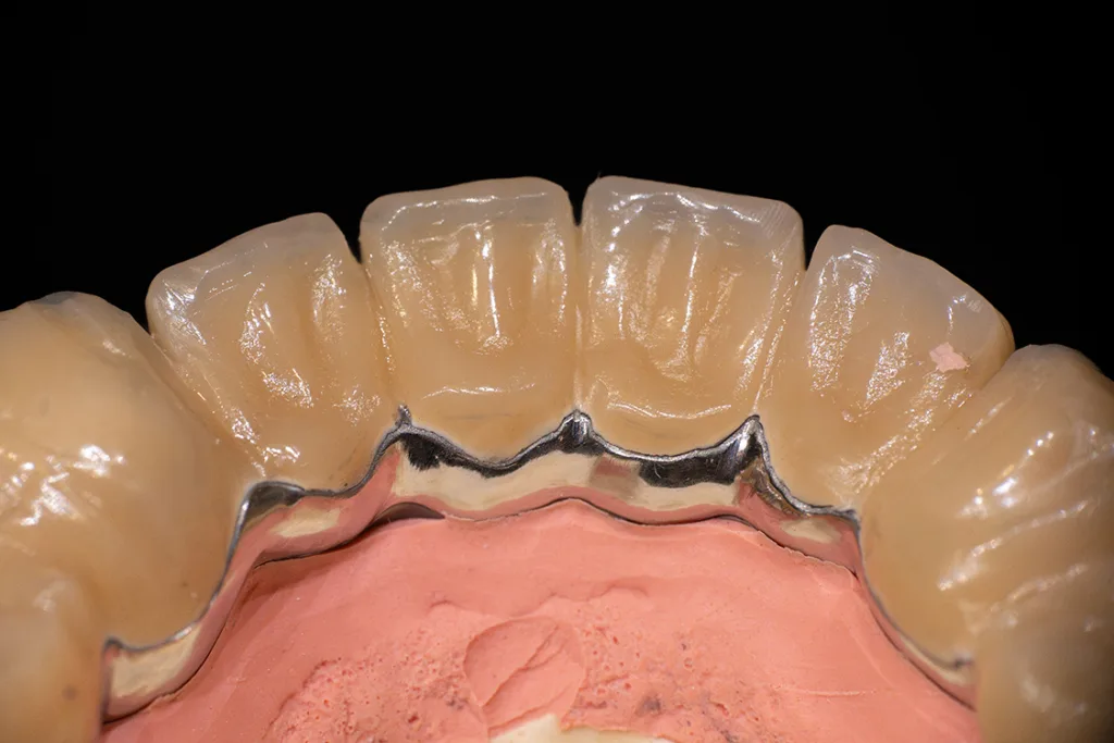 Abb. 28: Eine schöne Lingualfläche im Unterkiefer.