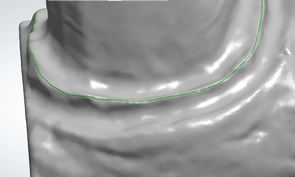 Abb. 5: Festlegen der Präparationsgrenzen.