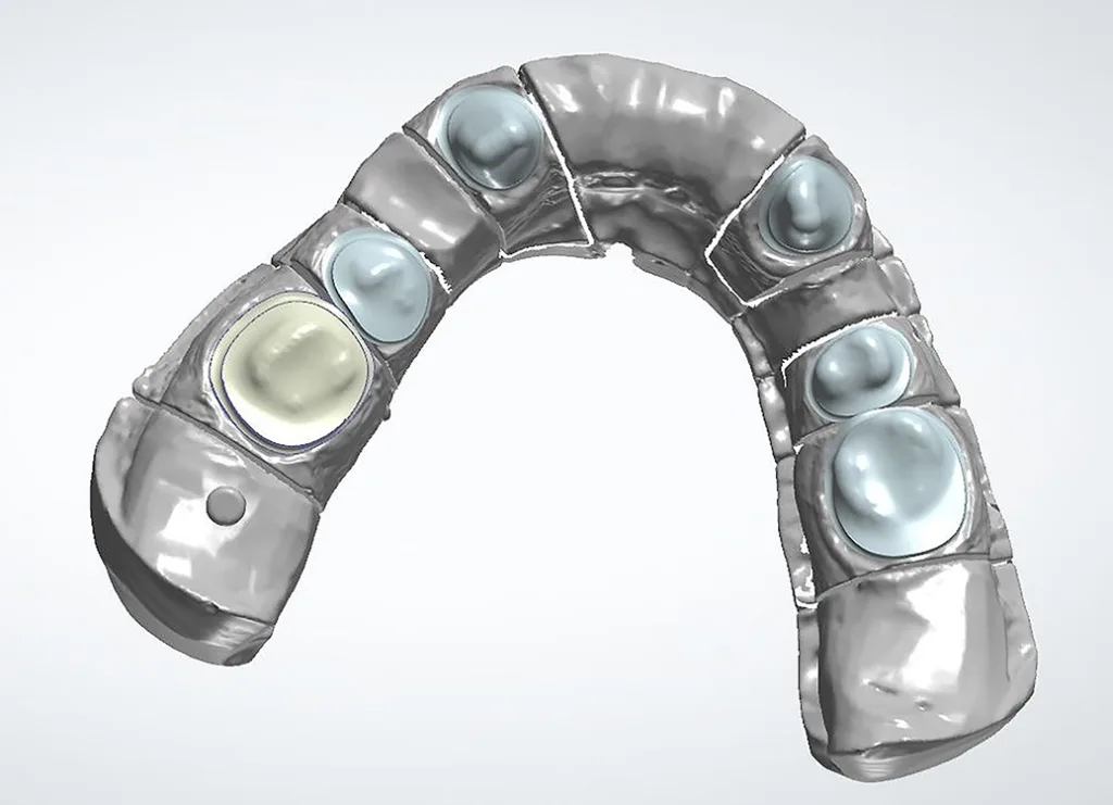 Abb. 6: Kronenböden festlegen.