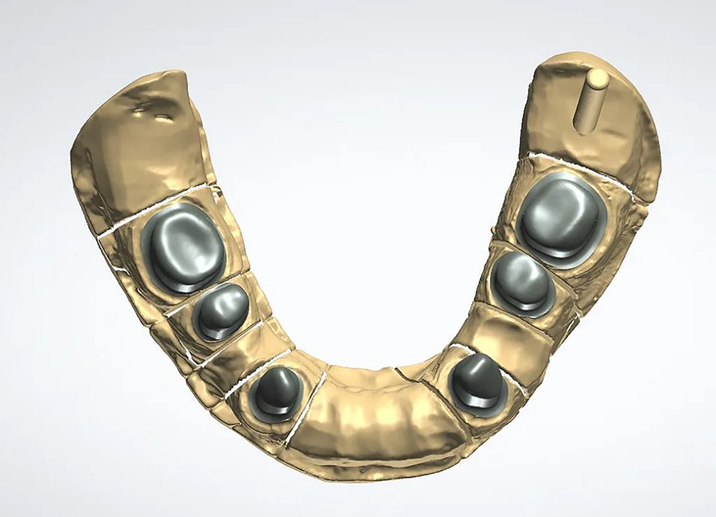 Abb. 8: Fertig designte Primärteleskope UK in okklusaler Ansicht.
