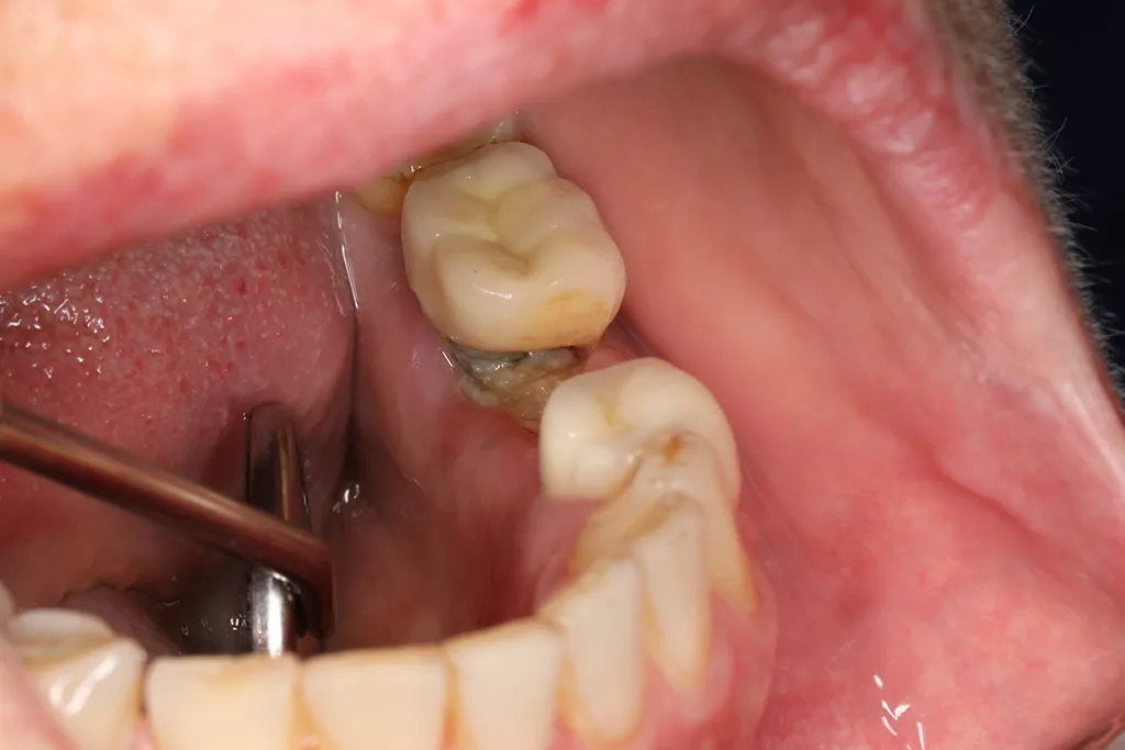Abb. 2: Medikamentenassoziierte Osteonekrose der Kiefer (MRONJ).