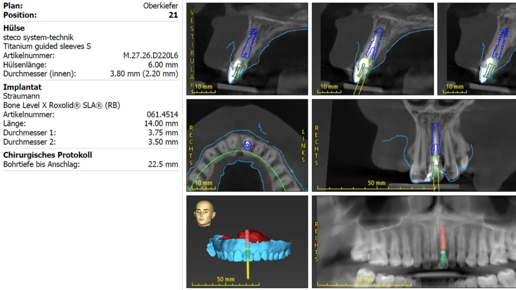 Abb. 2: Digitale Implantatplanung in coDiagnostiX® mit virtueller Zahnextraktion und prothetisch geführter Implantatposition.