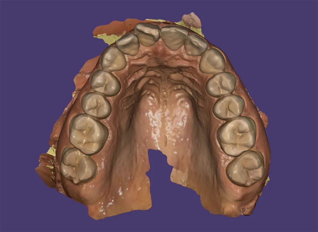 Abb. 1: Okklusale Ansicht des intraoralen Scans des Oberkiefers als Grundlage der digitalen Datenerfassung.