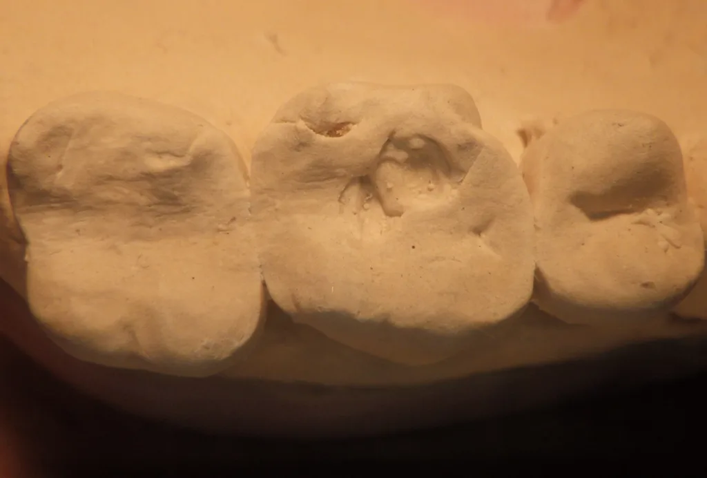 Abb. 1: Ausgangssituation in Gips, ein- und durchgeschliffene Okklusion.