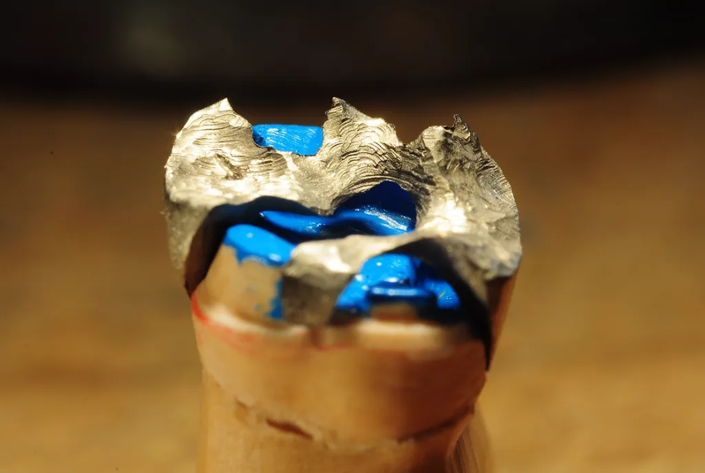 Abb. 3: Das durchgeschliffene Inlay auf der neuen Präparation zeigt, wie viel Zahnsubstanz nun geopfert wurde, um eine dauerhafte Funktion zu gewährleisten.