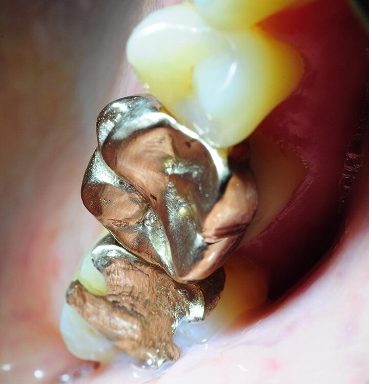 Abb. 5: Ein starker Kontakt ist nach dem Eingliedern an der mesialen Randleiste erkennbar.