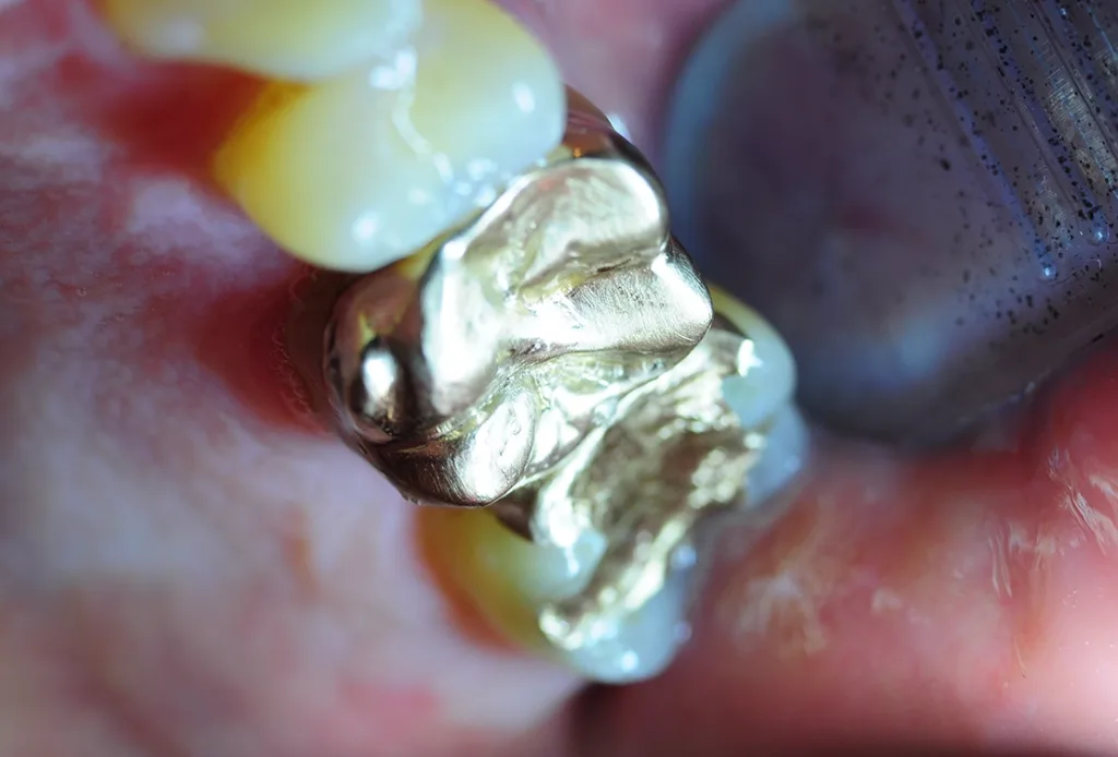 Abb. 6: Ein starker Kontakt auf dem distopalatinalen Abhang des mesiobukkalen Höckers.