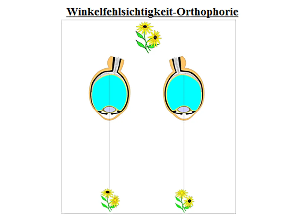 Abb. 2: Winkelfehlsichtigkeit-Orthophorie