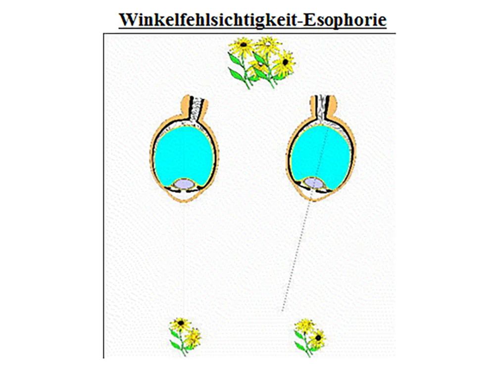 Abb. 3: Winkelfehlsichtigkeit-Esophorie