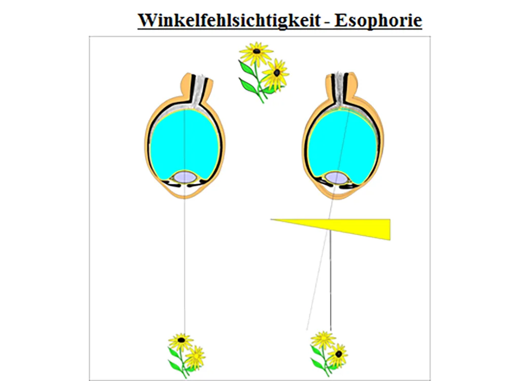 Abb. 4: Winkelfehlsichtigkeit-Esophorie durch Prisma korrigiert.