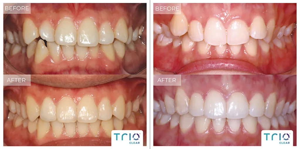 Vorher Nachher Bilder von Zähnen