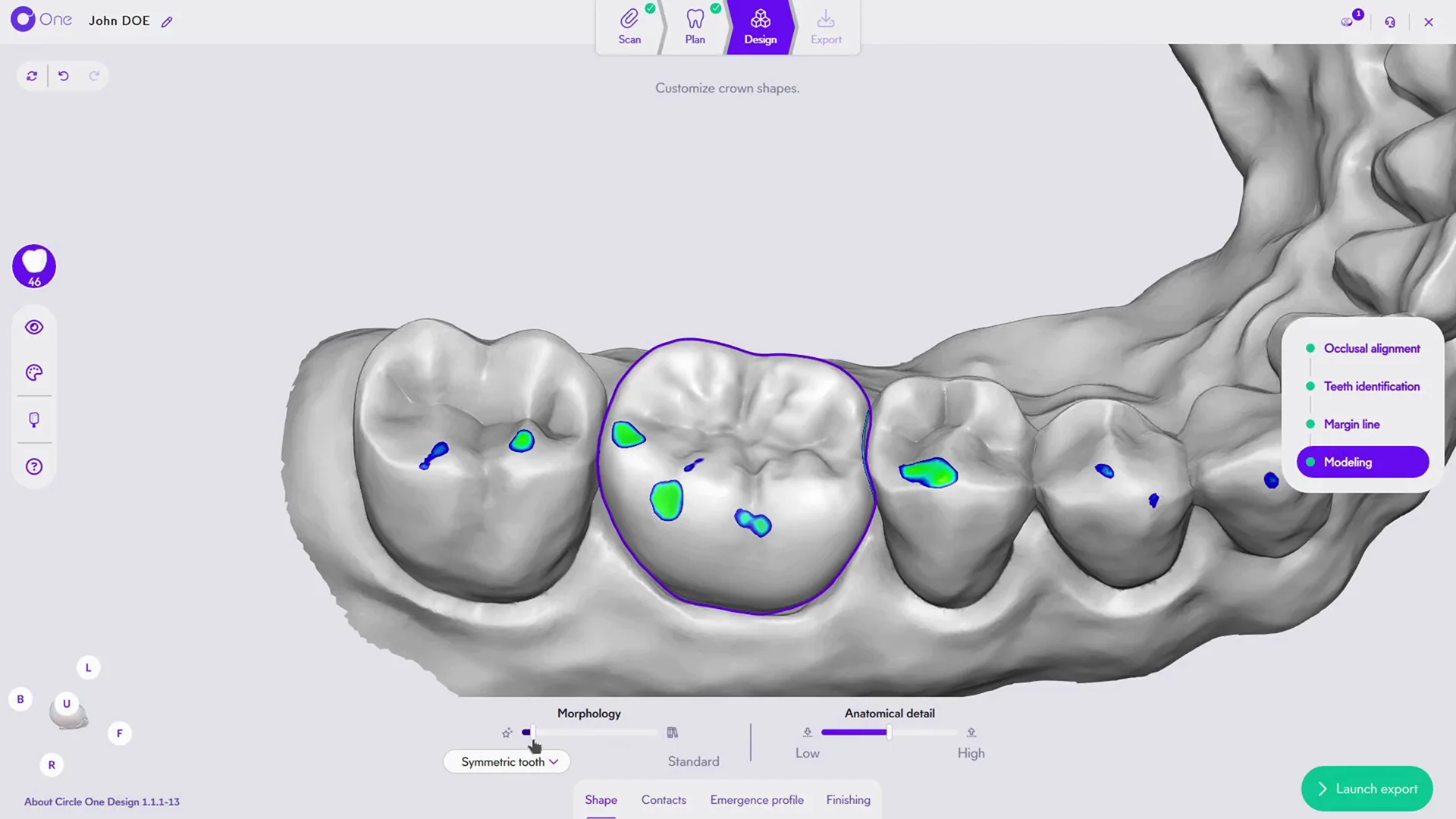 Intuitives, KI-gestütztes Modelling in Circle One: Die Software erzeugt anatomisch präzise Kronenvorschläge in Sekunden und ermöglicht Zahnärztinnen und Zahnärzten eine sofortige, intuitive Feinanpassung.
