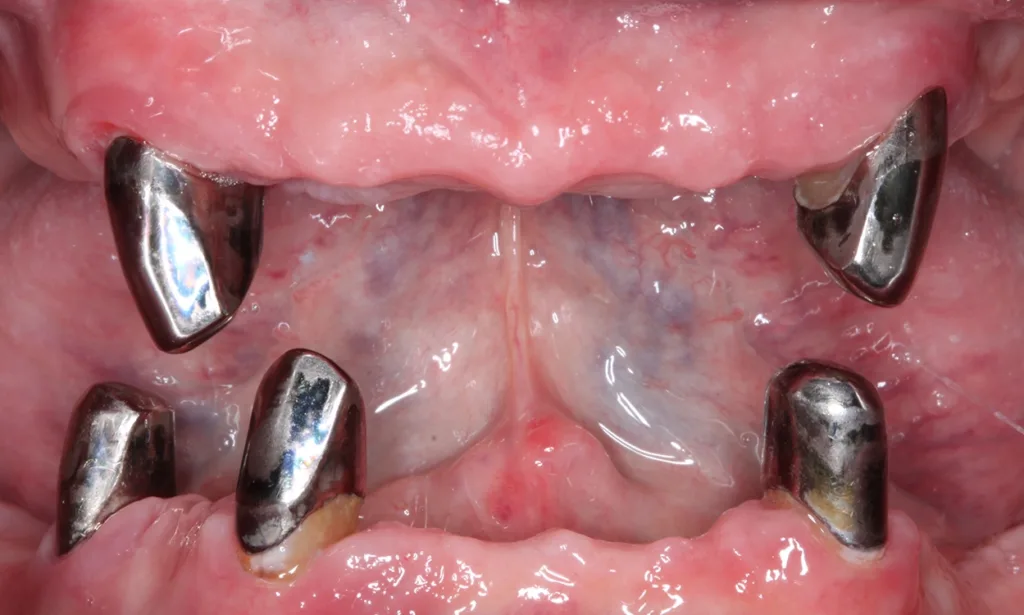 Abb. 3 a–e: Klinische Dokumentation eines 63-jahrigen männlichen Patienten (geb. 05.09.1961). Die Fotodokumentation erfolgte erst am Tag der AIT und nicht im Rahmen der klinischen und radiologischen und 47 wurden vor der AIT entfernt. An den Zahnen 13 und 23 war neben der peniblen subgingivalen Instrumentierung die Applikation von Straumann® Emdogain® (Straumann Group, Basel, Schweiz) vorgesehen.