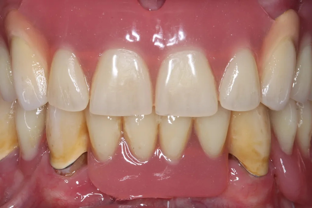Abb. 3 a–e: Klinische Dokumentation eines 63-jahrigen männlichen Patienten (geb. 05.09.1961). Die Fotodokumentation erfolgte erst am Tag der AIT und nicht im Rahmen der klinischen und radiologischen und 47 wurden vor der AIT entfernt. An den Zahnen 13 und 23 war neben der peniblen subgingivalen Instrumentierung die Applikation von Straumann® Emdogain® (Straumann Group, Basel, Schweiz) vorgesehen.
