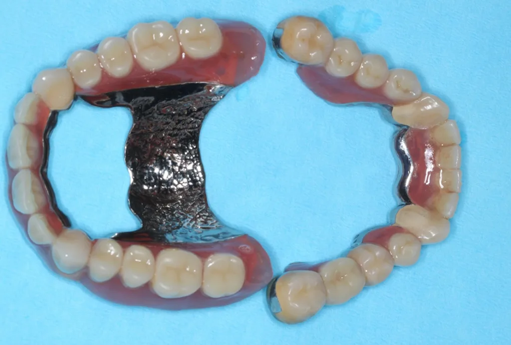 Abb. 3 a–e: Klinische Dokumentation eines 63-jahrigen männlichen Patienten (geb. 05.09.1961). Die Fotodokumentation erfolgte erst am Tag der AIT und nicht im Rahmen der klinischen und radiologischen und 47 wurden vor der AIT entfernt. An den Zahnen 13 und 23 war neben der peniblen subgingivalen Instrumentierung die Applikation von Straumann® Emdogain® (Straumann Group, Basel, Schweiz) vorgesehen.