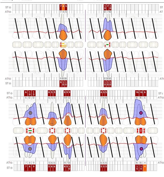 Abb. 3 a–e: Klinische Dokumentation eines 63-jahrigen männlichen Patienten (geb. 05.09.1961). Die Fotodokumentation erfolgte erst am Tag der AIT und nicht im Rahmen der klinischen und radiologischen und 47 wurden vor der AIT entfernt. An den Zahnen 13 und 23 war neben der peniblen subgingivalen Instrumentierung die Applikation von Straumann® Emdogain® (Straumann Group, Basel, Schweiz) vorgesehen.