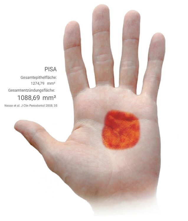 Abb. 3 a–e: Klinische Dokumentation eines 63-jahrigen männlichen Patienten (geb. 05.09.1961). Die Fotodokumentation erfolgte erst am Tag der AIT und nicht im Rahmen der klinischen und radiologischen und 47 wurden vor der AIT entfernt. An den Zahnen 13 und 23 war neben der peniblen subgingivalen Instrumentierung die Applikation von Straumann® Emdogain® (Straumann Group, Basel, Schweiz) vorgesehen.