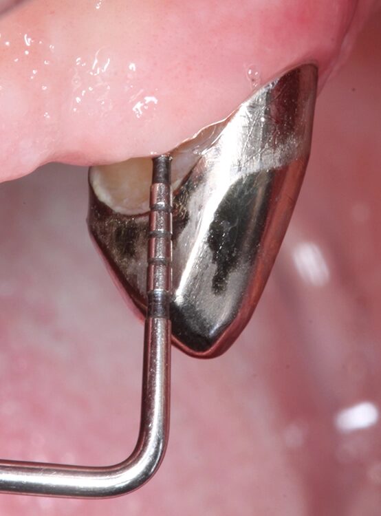 Abb. 4 a–j: Mögliche Variante des schrittweisen klinischen Vorgehens zur Anwendung von Straumann® Emdogain® im Rahmen einer initialen NCPT an Zahn 23. a)Initiale Sondierungstiefe, b) nach der Applikation der Lokalanästhesie erfolgt die subgingivale Instrumentierung mit Ultraschall und c) Pulverwasserstrahlgemischen (AIRFLOW® PLUS Pulver, EMS, Nyon, Schweiz), d) Spülung mit H2O2 3%, e) Spülung mit physiologischer Kochsalzlösung, f) Applikation einer konditionierenden EDTA-Lösung (Straumann® PrefGel®, Straumann Group, Basel, Schweiz), g) Trocknung und Blutstillung durch Einbringen von sterilisiertem Superfloss, h) Zahn 23 vorbereitet für die Applikation von SMP (Straumann® Emdogain®, Straumann Group, Basel, Schweiz), i) Applikation von Straumann® Emdogain®, j) Applikation von Histoacryl® Gewebekleber (B. Braun, Tuttlingen, Deutschland)