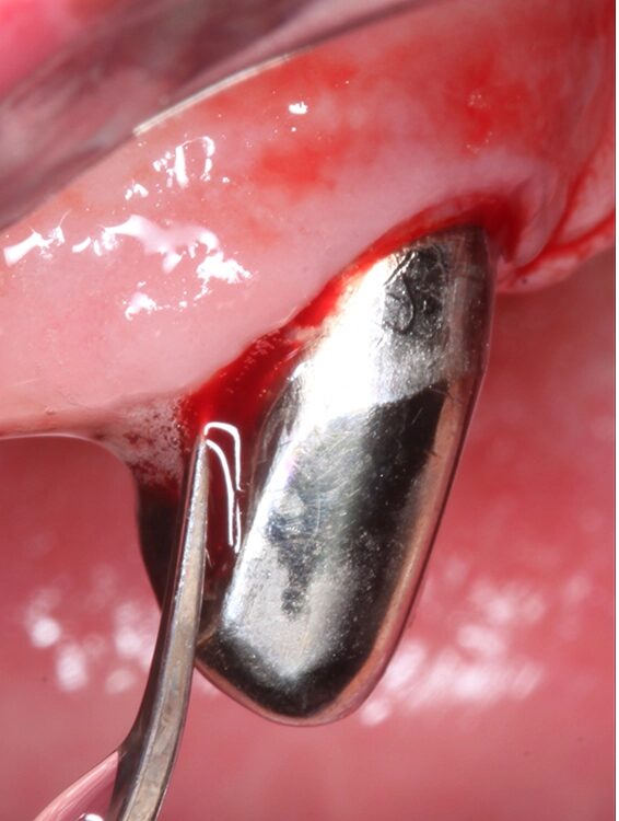Abb. 4 a–j: Mögliche Variante des schrittweisen klinischen Vorgehens zur Anwendung von Straumann® Emdogain® im Rahmen einer initialen NCPT an Zahn 23. a)Initiale Sondierungstiefe, b) nach der Applikation der Lokalanästhesie erfolgt die subgingivale Instrumentierung mit Ultraschall und c) Pulverwasserstrahlgemischen (AIRFLOW® PLUS Pulver, EMS, Nyon, Schweiz), d) Spülung mit H2O2 3%, e) Spülung mit physiologischer Kochsalzlösung, f) Applikation einer konditionierenden EDTA-Lösung (Straumann® PrefGel®, Straumann Group, Basel, Schweiz), g) Trocknung und Blutstillung durch Einbringen von sterilisiertem Superfloss, h) Zahn 23 vorbereitet für die Applikation von SMP (Straumann® Emdogain®, Straumann Group, Basel, Schweiz), i) Applikation von Straumann® Emdogain®, j) Applikation von Histoacryl® Gewebekleber (B. Braun, Tuttlingen, Deutschland)