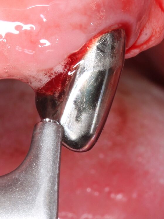 Abb. 4 a–j: Mögliche Variante des schrittweisen klinischen Vorgehens zur Anwendung von Straumann® Emdogain® im Rahmen einer initialen NCPT an Zahn 23. a)Initiale Sondierungstiefe, b) nach der Applikation der Lokalanästhesie erfolgt die subgingivale Instrumentierung mit Ultraschall und c) Pulverwasserstrahlgemischen (AIRFLOW® PLUS Pulver, EMS, Nyon, Schweiz), d) Spülung mit H2O2 3%, e) Spülung mit physiologischer Kochsalzlösung, f) Applikation einer konditionierenden EDTA-Lösung (Straumann® PrefGel®, Straumann Group, Basel, Schweiz), g) Trocknung und Blutstillung durch Einbringen von sterilisiertem Superfloss, h) Zahn 23 vorbereitet für die Applikation von SMP (Straumann® Emdogain®, Straumann Group, Basel, Schweiz), i) Applikation von Straumann® Emdogain®, j) Applikation von Histoacryl® Gewebekleber (B. Braun, Tuttlingen, Deutschland)