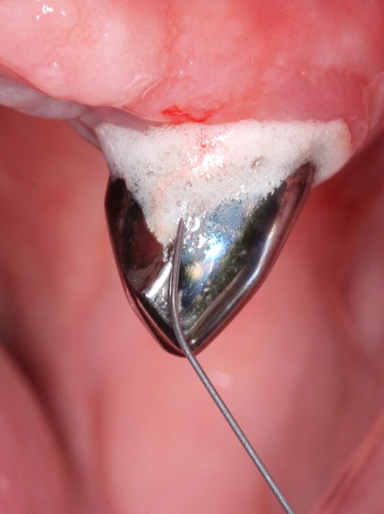 Abb. 4 a–j: Mögliche Variante des schrittweisen klinischen Vorgehens zur Anwendung von Straumann® Emdogain® im Rahmen einer initialen NCPT an Zahn 23. a)Initiale Sondierungstiefe, b) nach der Applikation der Lokalanästhesie erfolgt die subgingivale Instrumentierung mit Ultraschall und c) Pulverwasserstrahlgemischen (AIRFLOW® PLUS Pulver, EMS, Nyon, Schweiz), d) Spülung mit H2O2 3%, e) Spülung mit physiologischer Kochsalzlösung, f) Applikation einer konditionierenden EDTA-Lösung (Straumann® PrefGel®, Straumann Group, Basel, Schweiz), g) Trocknung und Blutstillung durch Einbringen von sterilisiertem Superfloss, h) Zahn 23 vorbereitet für die Applikation von SMP (Straumann® Emdogain®, Straumann Group, Basel, Schweiz), i) Applikation von Straumann® Emdogain®, j) Applikation von Histoacryl® Gewebekleber (B. Braun, Tuttlingen, Deutschland)