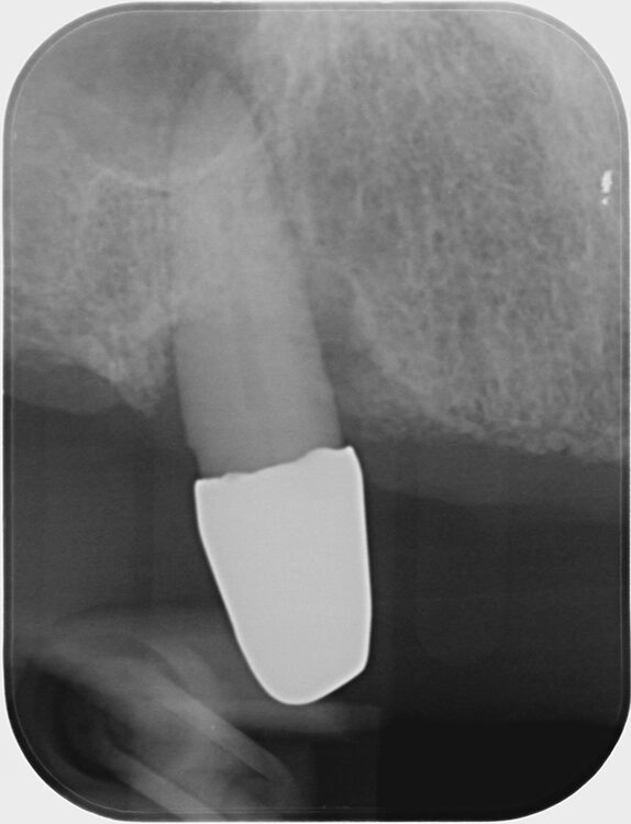Abb. 6 a–h: Klinische und radiologische Dokumentation 7 Monate nach der AIT und der Applikation von Straumann® Emdogain® an den Zähnen 13 und 23. Die Sondierungstiefen und die parodontal entzündete Wundfläche haben sich im Vergleich zu den initialen Befunden deutlich reduziert. Es lagen keine Sondierungstiefen >5 mm vor. Das bedeutet, es bestand zu diesem Zeitpunkt keine Indikation für ein weiteres ggf. chirurgisches Vorgehen.