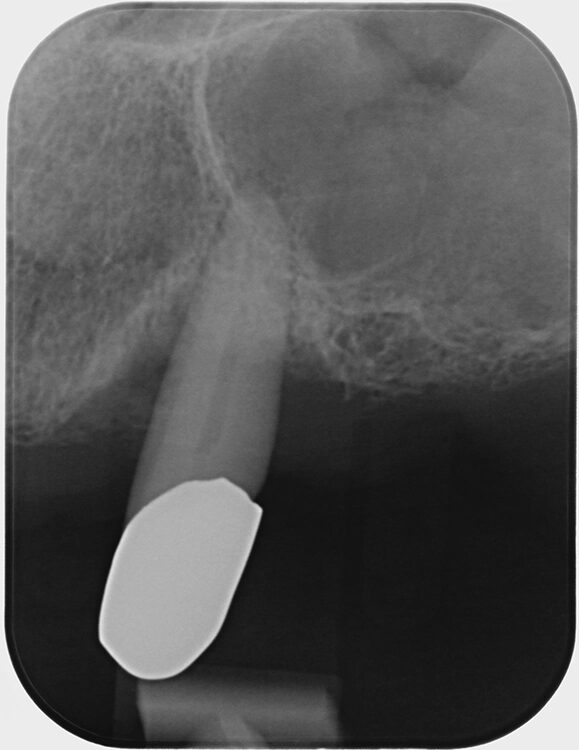 Abb. 6 a–h: Klinische und radiologische Dokumentation 7 Monate nach der AIT und der Applikation von Straumann® Emdogain® an den Zähnen 13 und 23. Die Sondierungstiefen und die parodontal entzündete Wundfläche haben sich im Vergleich zu den initialen Befunden deutlich reduziert. Es lagen keine Sondierungstiefen >5 mm vor. Das bedeutet, es bestand zu diesem Zeitpunkt keine Indikation für ein weiteres ggf. chirurgisches Vorgehen.