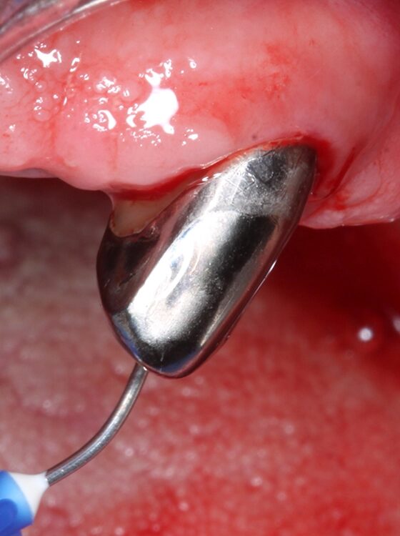 Abb. 4 a–j: Mögliche Variante des schrittweisen klinischen Vorgehens zur Anwendung von Straumann® Emdogain® im Rahmen einer initialen NCPT an Zahn 23. a)Initiale Sondierungstiefe, b) nach der Applikation der Lokalanästhesie erfolgt die subgingivale Instrumentierung mit Ultraschall und c) Pulverwasserstrahlgemischen (AIRFLOW® PLUS Pulver, EMS, Nyon, Schweiz), d) Spülung mit H2O2 3%, e) Spülung mit physiologischer Kochsalzlösung, f) Applikation einer konditionierenden EDTA-Lösung (Straumann® PrefGel®, Straumann Group, Basel, Schweiz), g) Trocknung und Blutstillung durch Einbringen von sterilisiertem Superfloss, h) Zahn 23 vorbereitet für die Applikation von SMP (Straumann® Emdogain®, Straumann Group, Basel, Schweiz), i) Applikation von Straumann® Emdogain®, j) Applikation von Histoacryl® Gewebekleber (B. Braun, Tuttlingen, Deutschland)